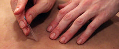 Community Acupuncture